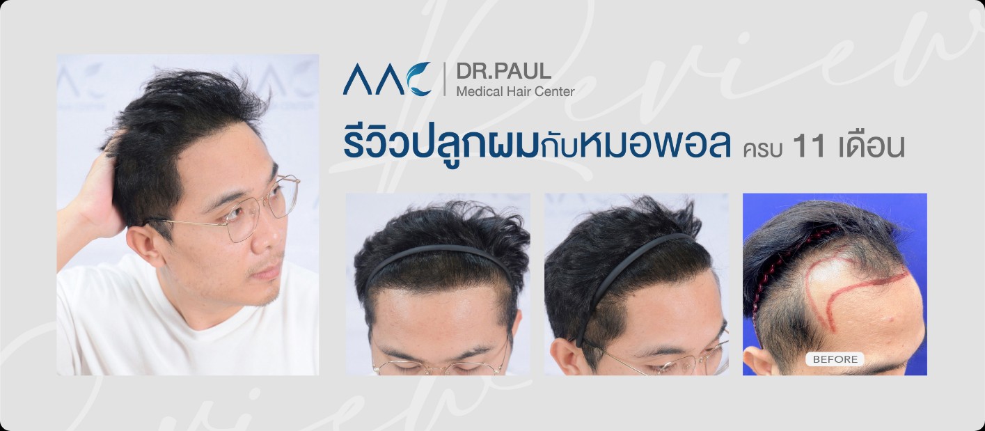 หลังปลูกผม