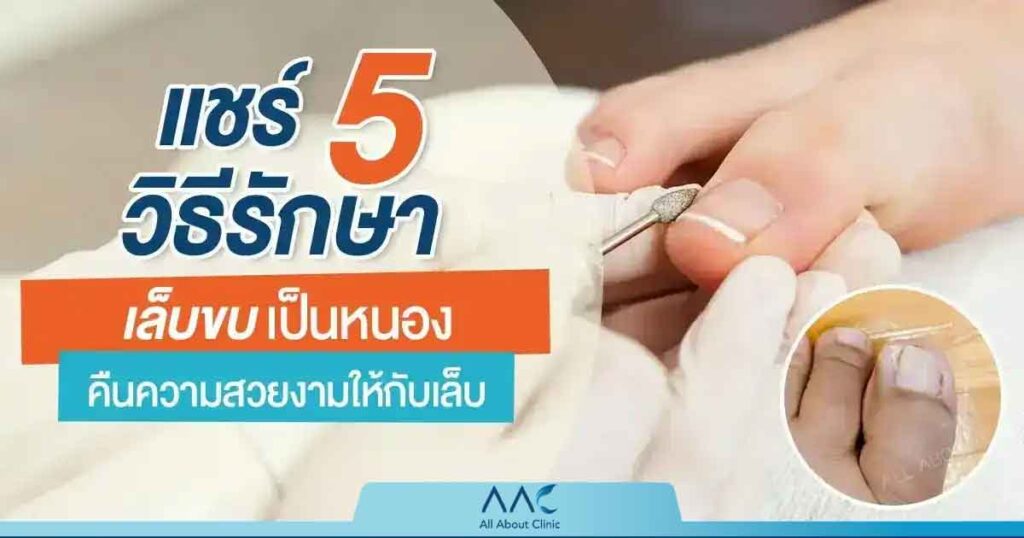 เล็บขบ เป็นหนอง