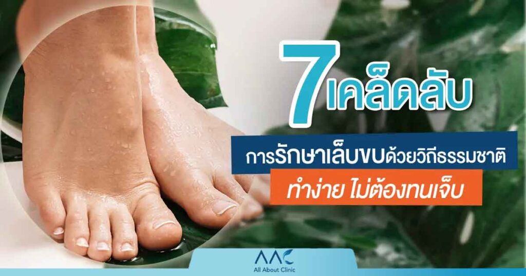 รักษาเล็บขบ