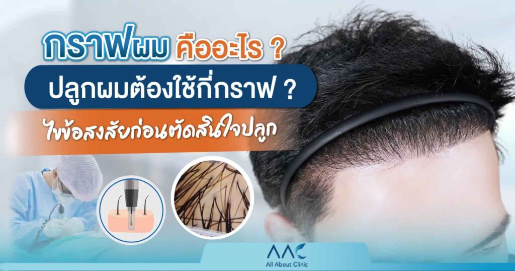 กราฟผม คืออะไร