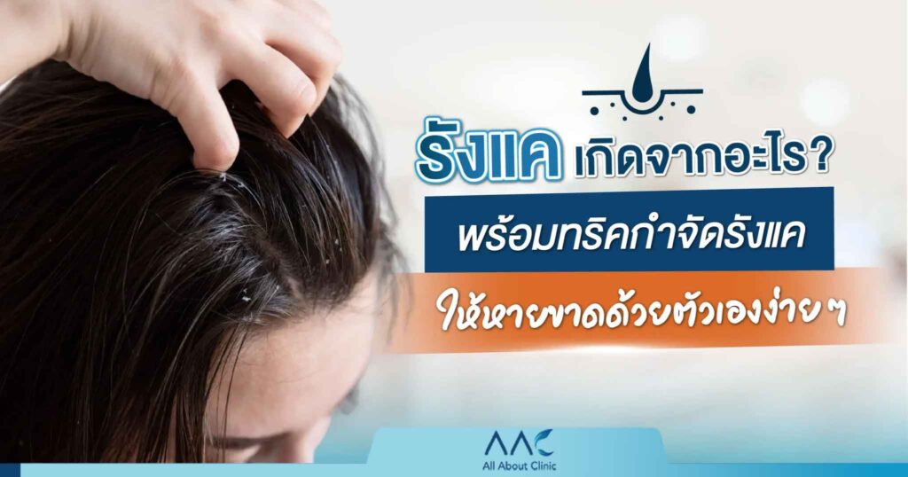 รังแคเกิดจากอะไร