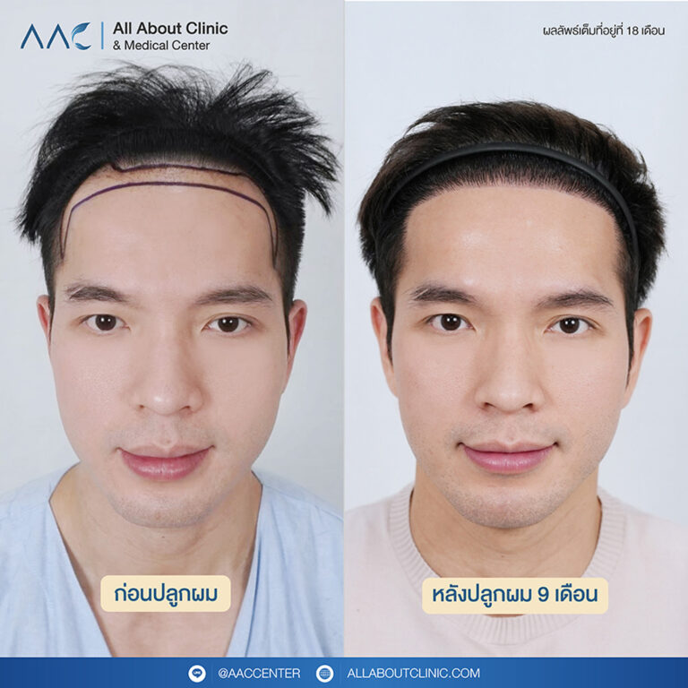 รีวิวหลังปลูกผม 9 เดือน