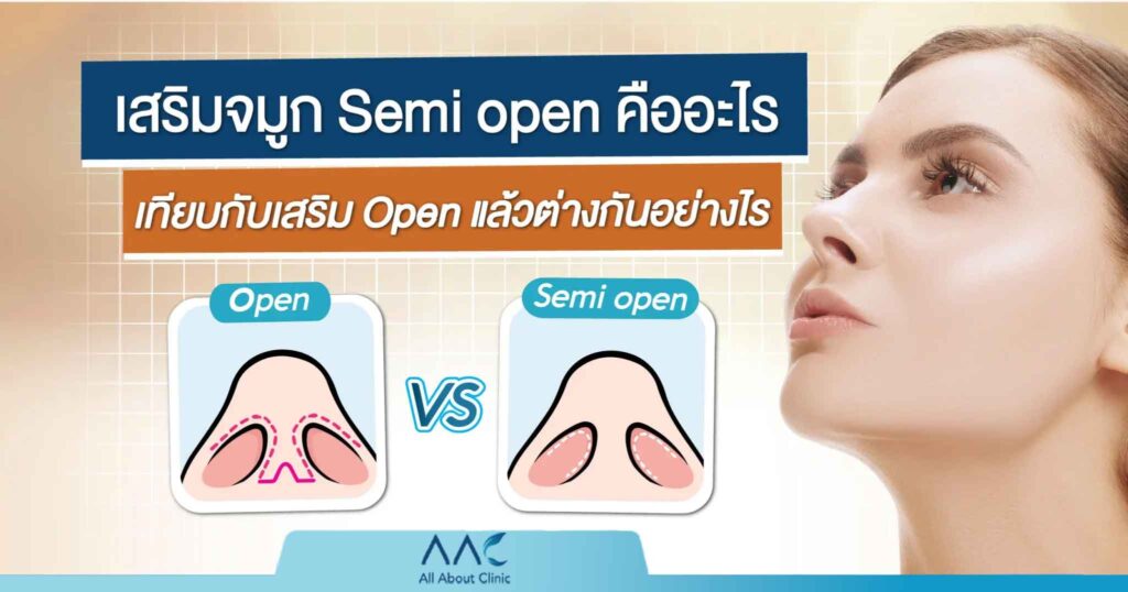 เสริมจมูก semi open