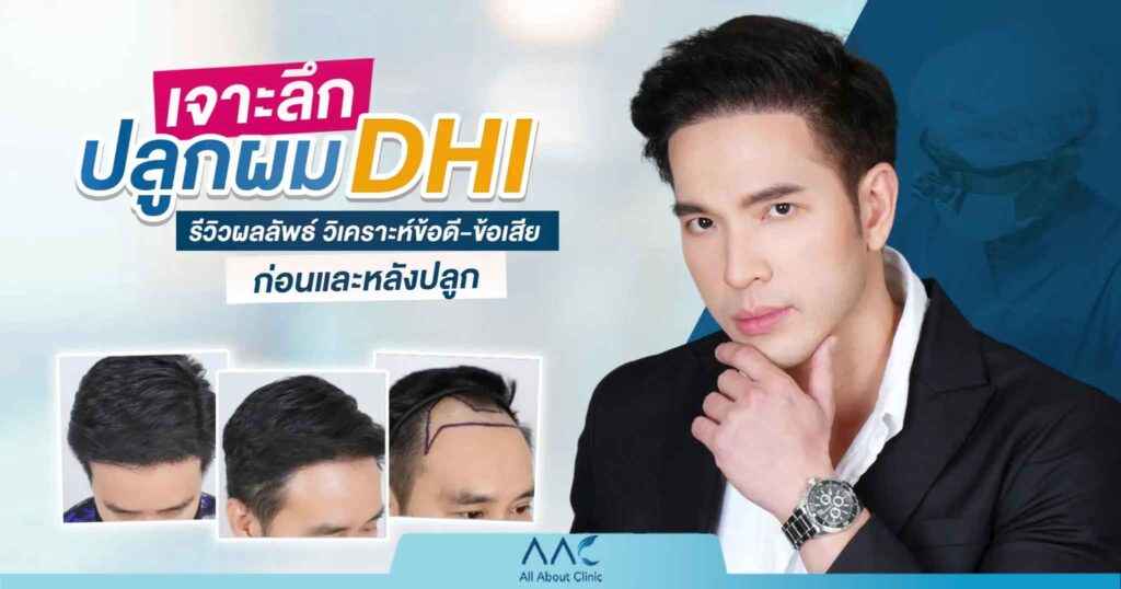 dhi ปลูกผม