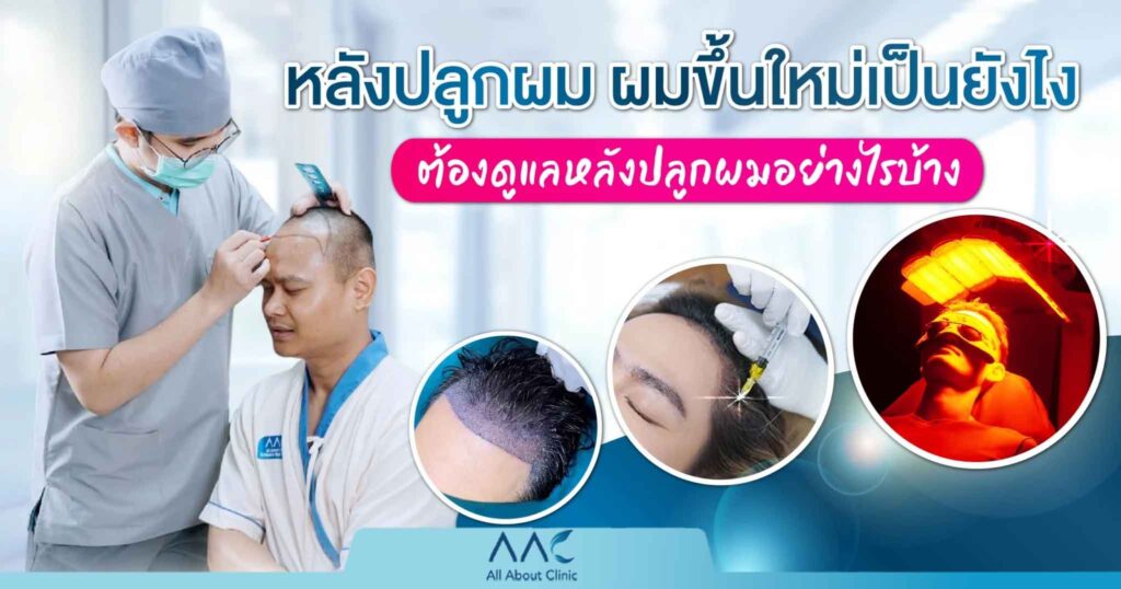 หลังปลูกผม