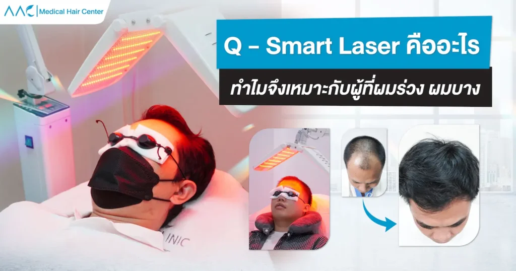 Q-Smart Laser คืออะไร ทำไมจึงเหมาะกับผู้ที่ผมร่วง ผมบาง