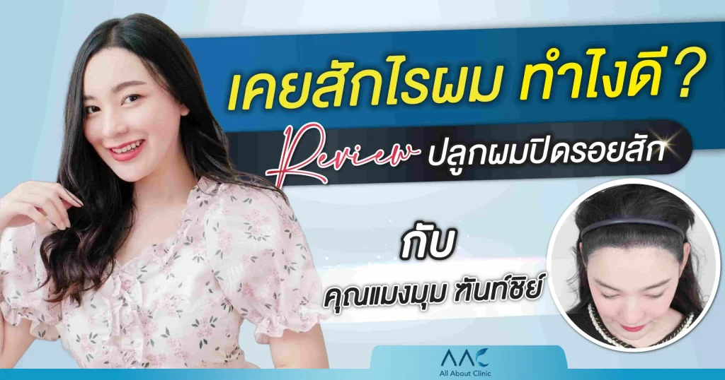 ปลูกผม ปิดรอยสัก