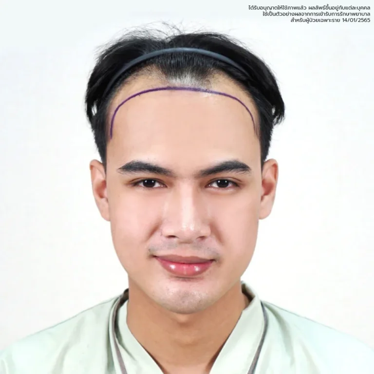 ปลูกผม