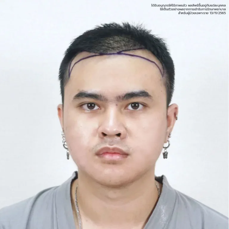 ปลูกผม