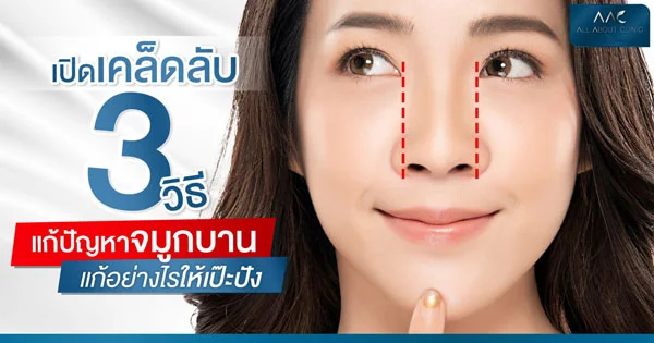 แก้จมูกบาน