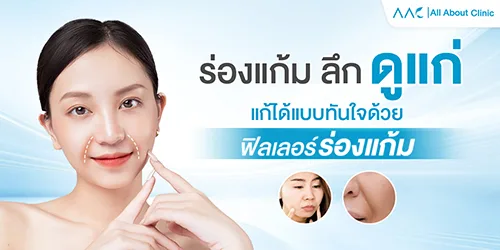 ร่องแก้ม, ฟิลเลอร์ร่องแก้ม