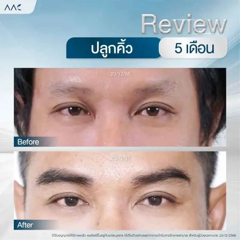 ปลูกคิ้ว-E080168-2-768x768