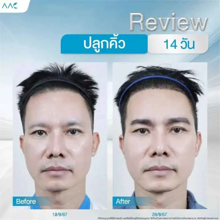 ปลูกคิ้ว-E080168-3-768x768
