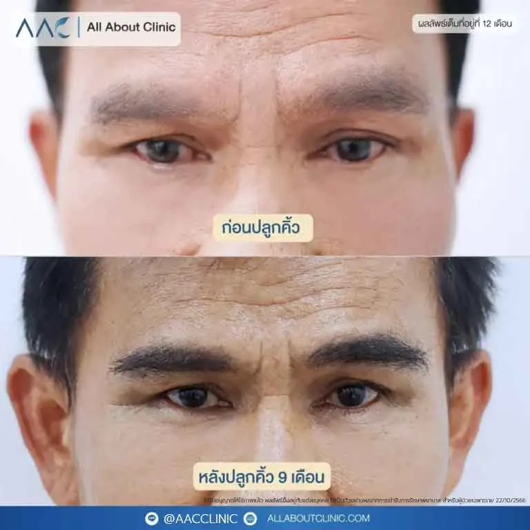 ปลูกคิ้ว-E080168-4-768x768