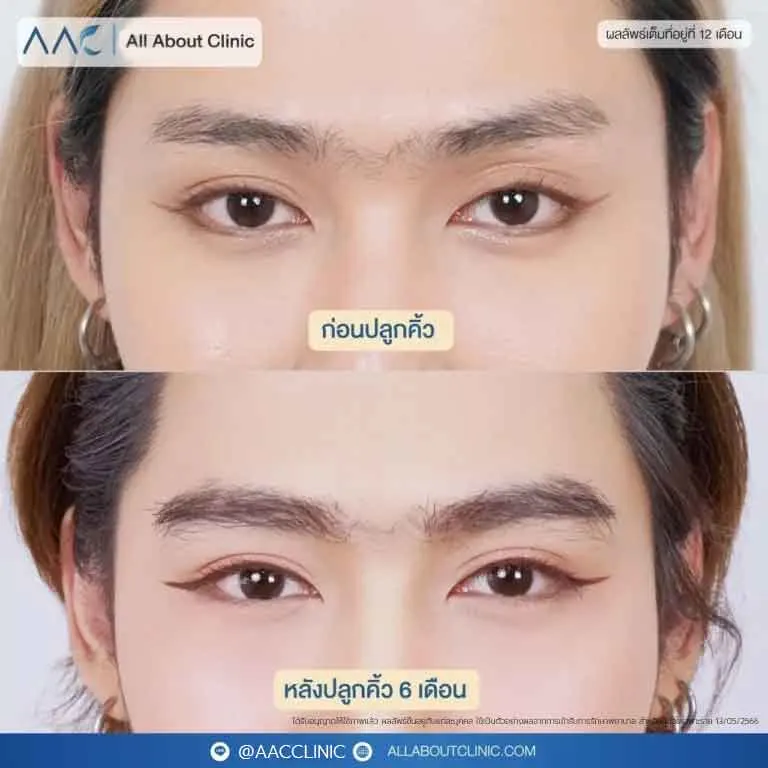 ปลูกคิ้ว-E080168-5-768x768
