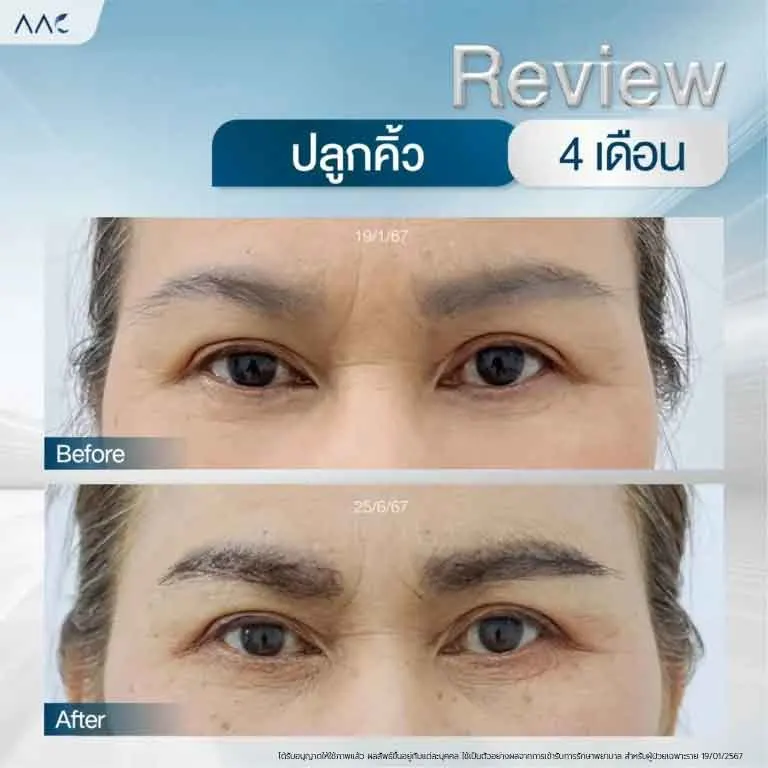 ปลูกคิ้ว-E080168-6-768x768