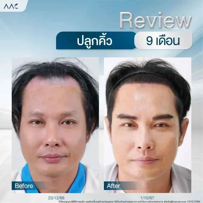 ปลูกคิ้ว-E080168-7-768x768