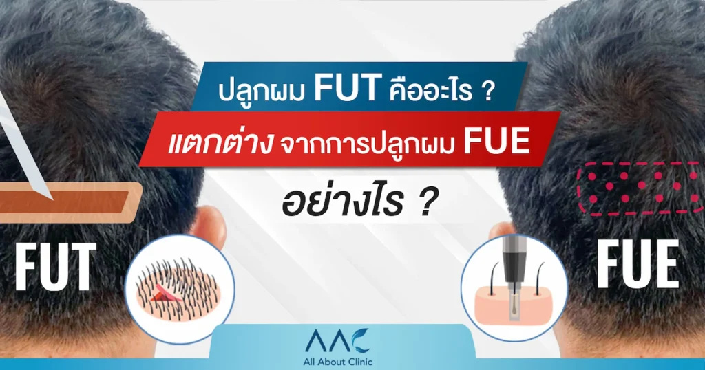 fut คืออะไร