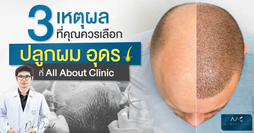 ปลูกผมอุดร