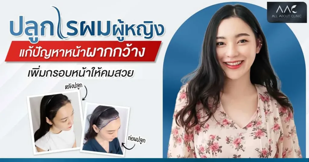 ปลูกไรผม ผู้หญิง