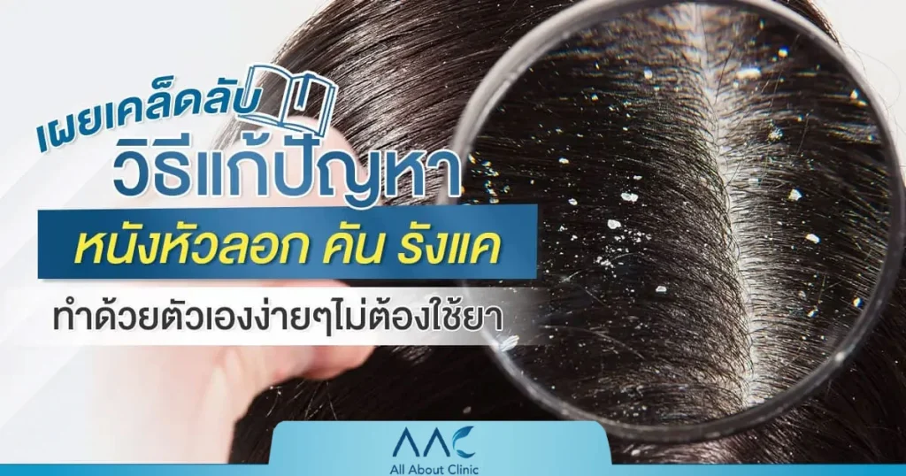 แก้ หนังหัวลอก รังแค คัน