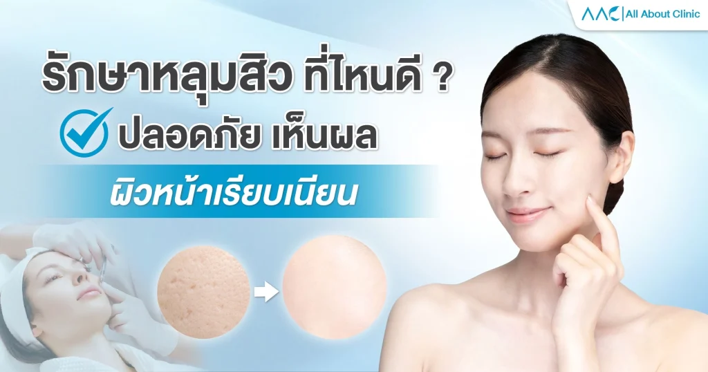 รักษาหลุมสิว ที่ไหนดี ?