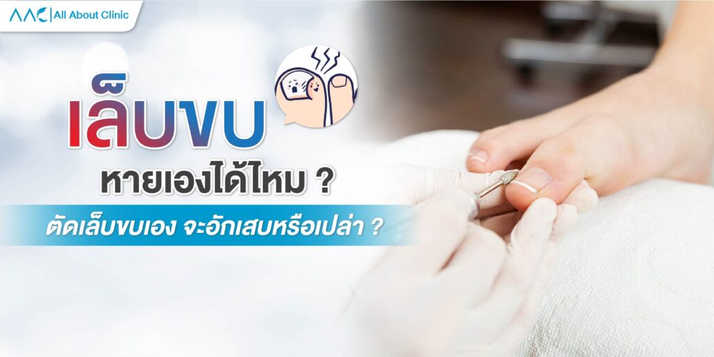 เล็บขบ